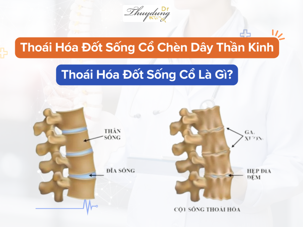 Thoái Hóa Đốt Sống Cổ Chèn Dây Thần Kinh