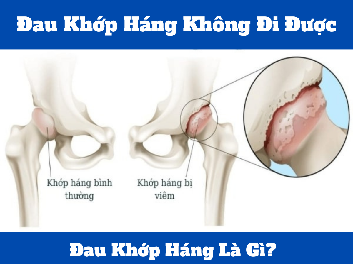 Đau Khớp Háng Không Đi Được