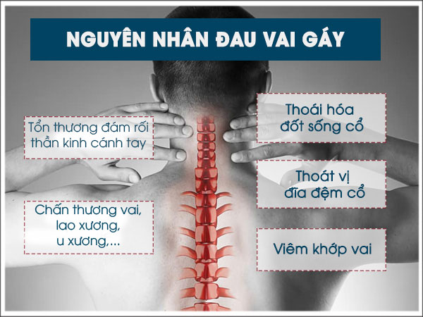 Nguyên Nhân Đau Mỏi Cổ Vai Gáy