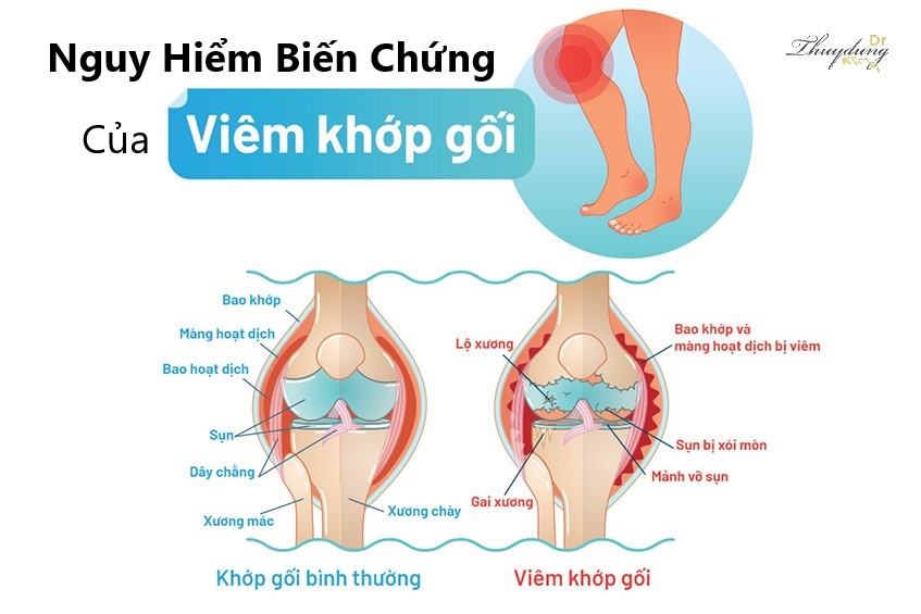 Nguy Hiểm Biến Chứng Của Viêm Khớp Gối