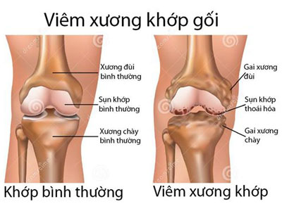  bệnh cơ xương khớp biến chứng nguy hiểm