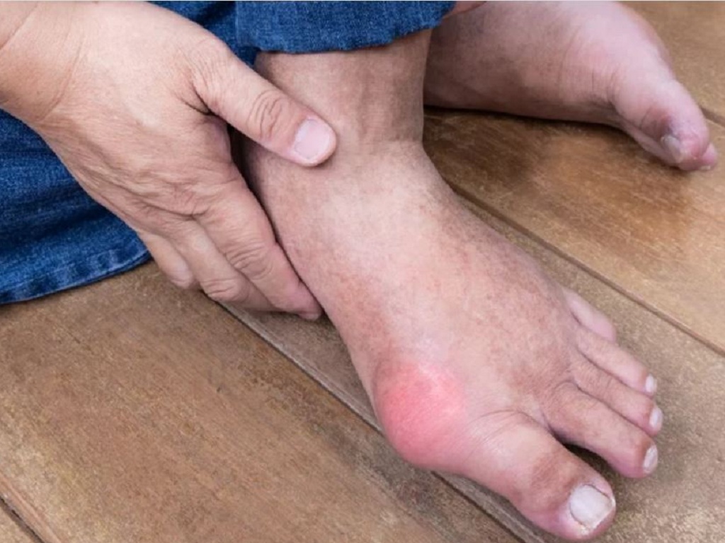 Dấu hiệu bệnh gout