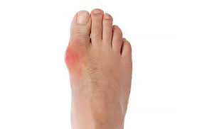 Dấu Hiệu Bệnh Gout