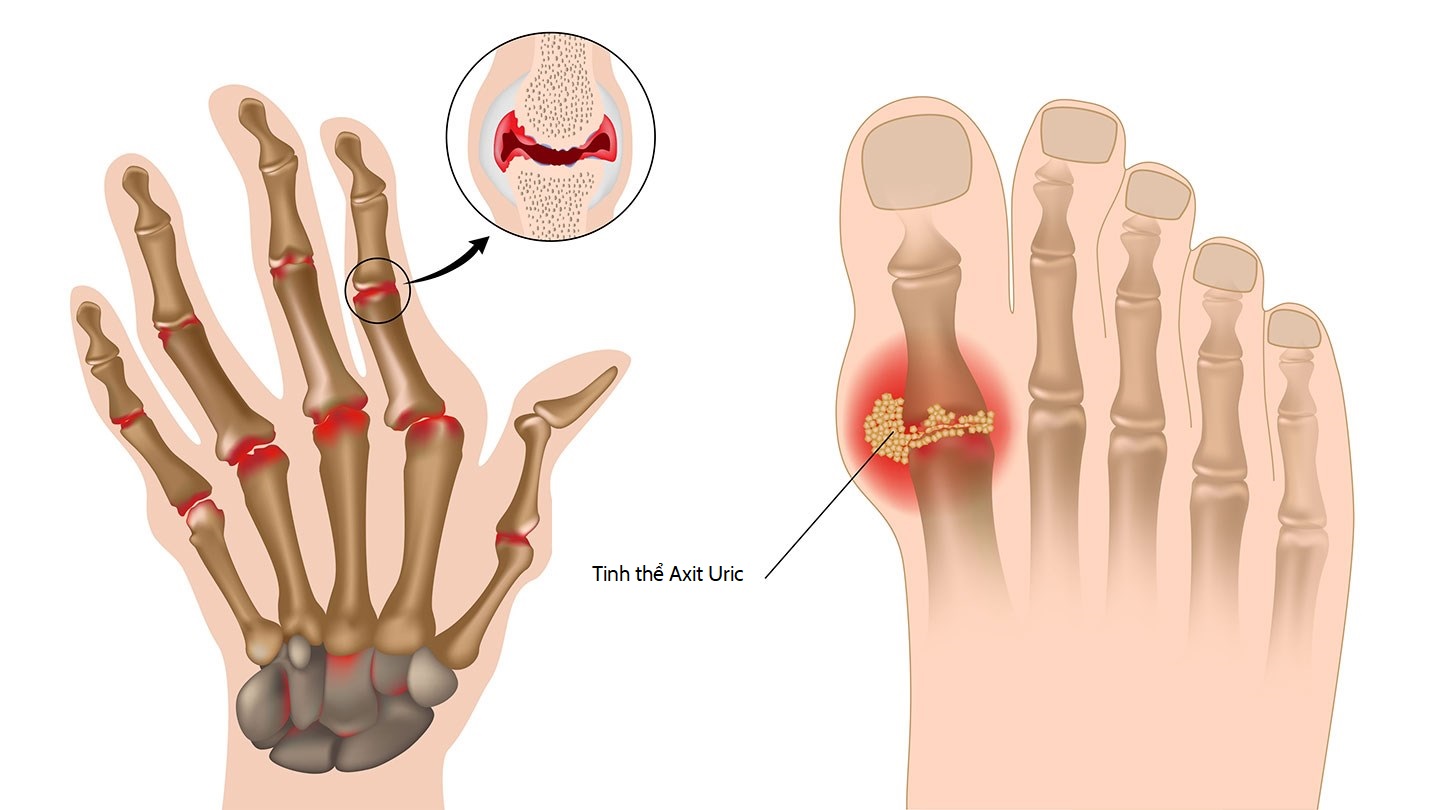 Dấu Hiệu Bệnh Gout