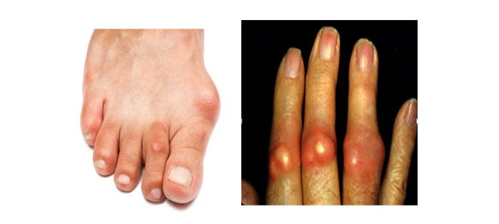 Dấu Hiệu Bệnh Gout