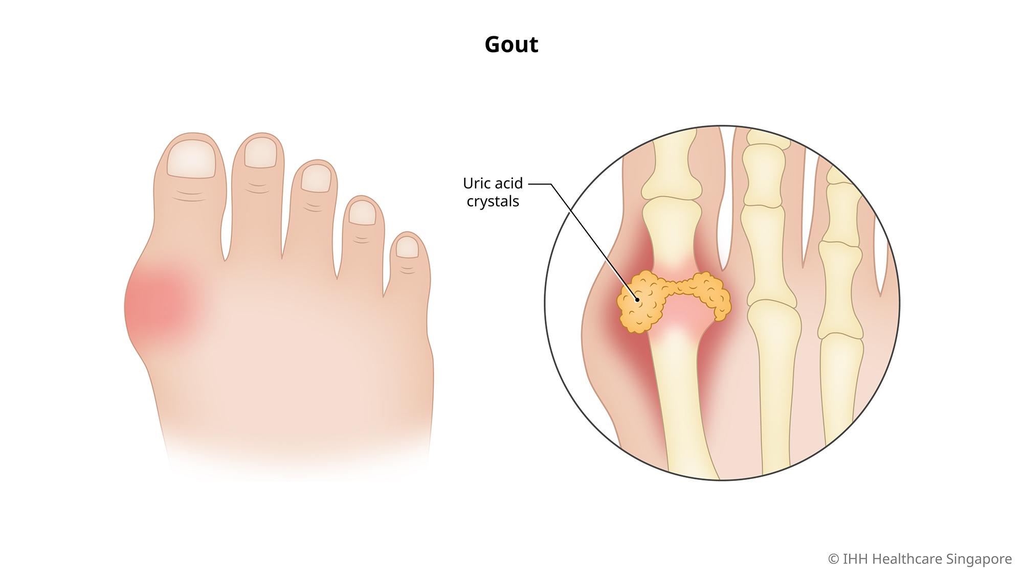 Dấu hiệu bệnh gout