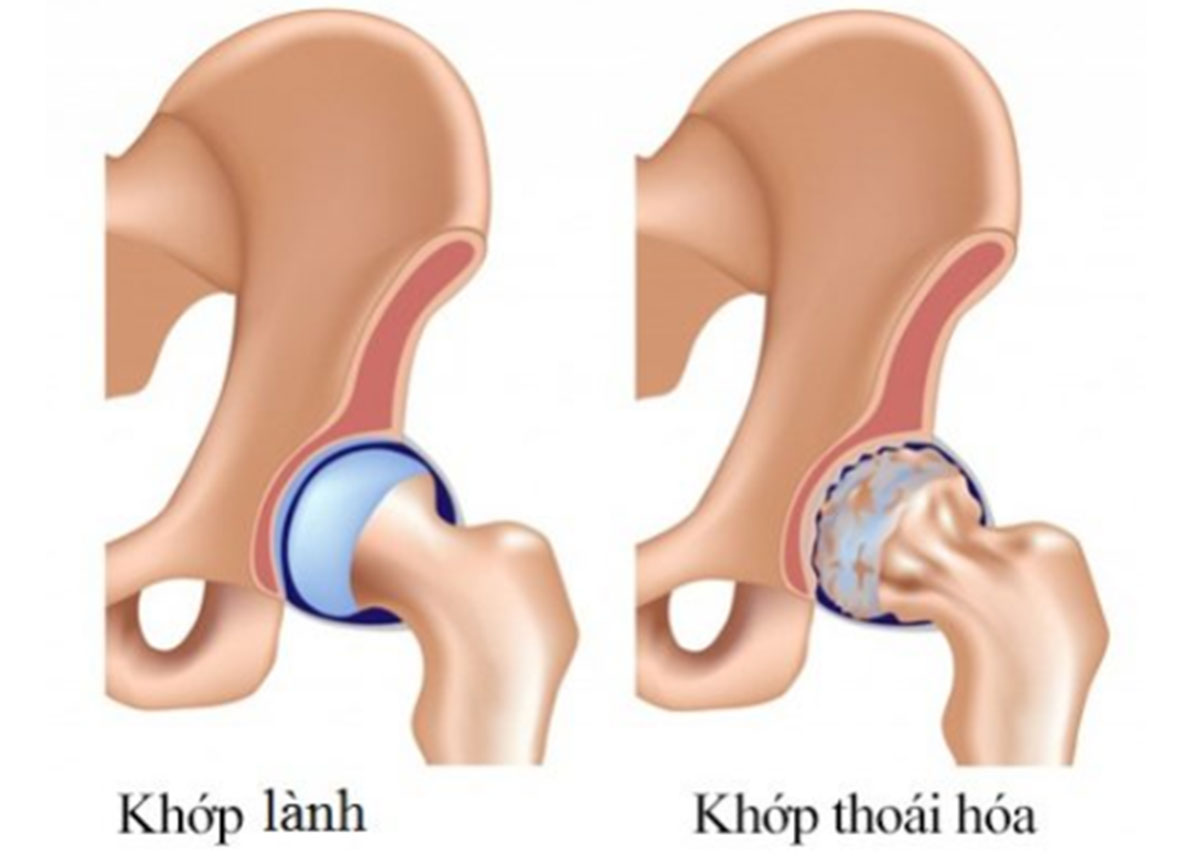 Thoái Hóa Khớp Háng