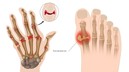 Dấu Hiệu Bệnh Gout