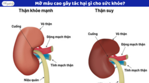 mỡ máu cao