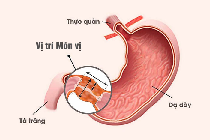 Dấu hiệu mắc hẹp môn vị dạ dày.