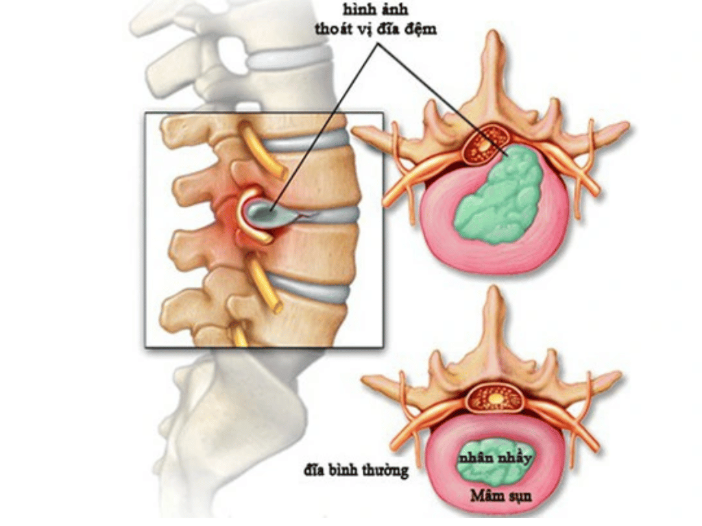 Thoát Vị Đĩa Đệm