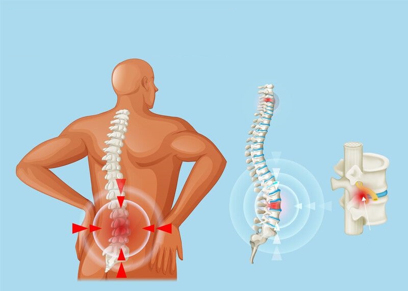 Khi bị thoát vị, bao xơ của đĩa đệm sẽ bị mòn hoặc rách, khiến nhân nhầy bên trong thoát ra ngoài