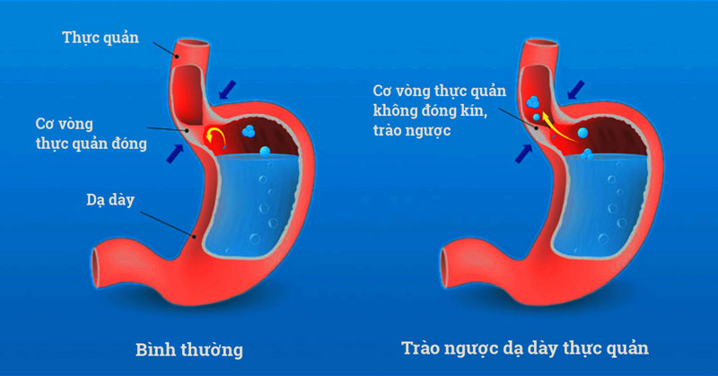 Tỷ lệ người mắc bệnh trào ngược dạ dày gia tăng nhanh chóng