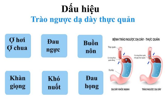 Dấu hiệu trào ngược dạ dày