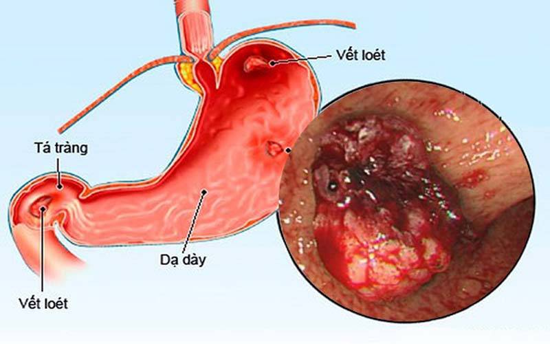 Tình trạng viêm loét dạ dày 