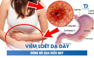 Bị Viêm Loét Dạ Dày Đừng Bỏ Qua Điều Này