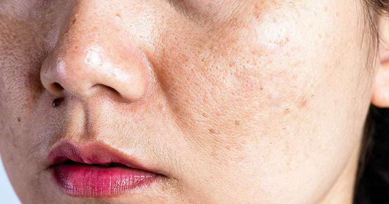 Da bị xỉn màu, lỗ chân lông to, xuất hiện mụn nội tiết và tăng tốc lão hóa do cơ thể bị quá tải lượng đường