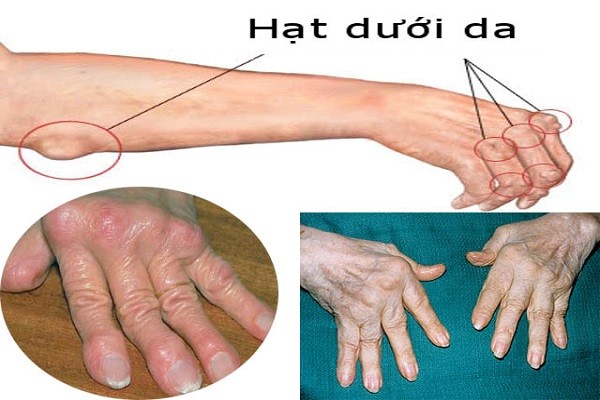 Viêm khớp dạng thấp có thể gây biến dạng khớp