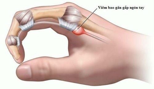 Xuất hiện tình trạng sưng, đau và hạn chế chuyển động của ngón tay
