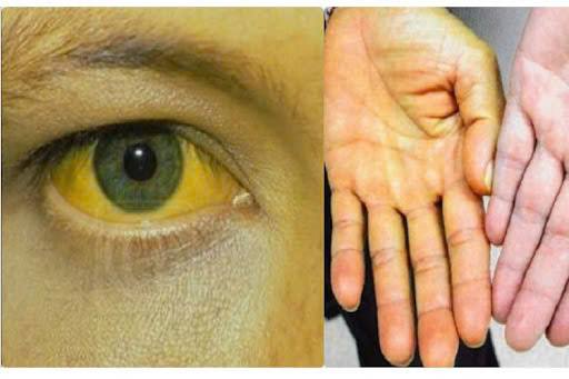 Bilirubin tích tụ trong máu sẽ thấm vào các mô và gây ra hiện tượng vàng da toàn thân